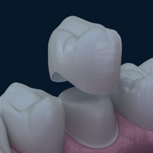 corona-dental-ceramica-blanes-girona